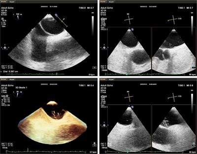 Case report: Malignant vasovagal reflex syndrome during percutaneous transcatheter closure of patent foramen ovale